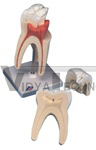 Upper Triple-Root Molar, 3 part